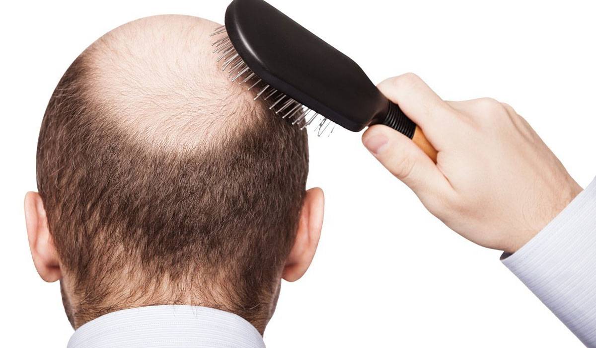 هذه الأطعمة تسبب تساقط الشعر