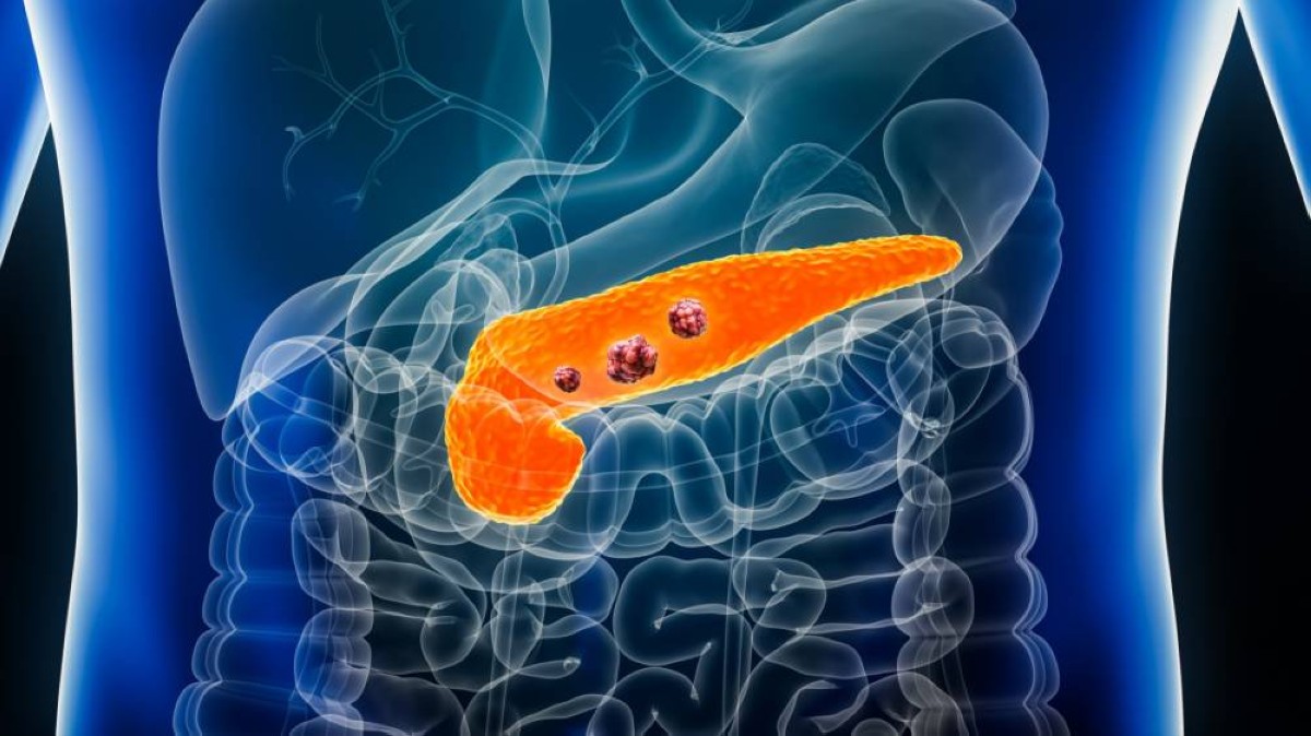 اكتشاف ثوري في علاقة الكوليسترول بسرطان البنكرياس