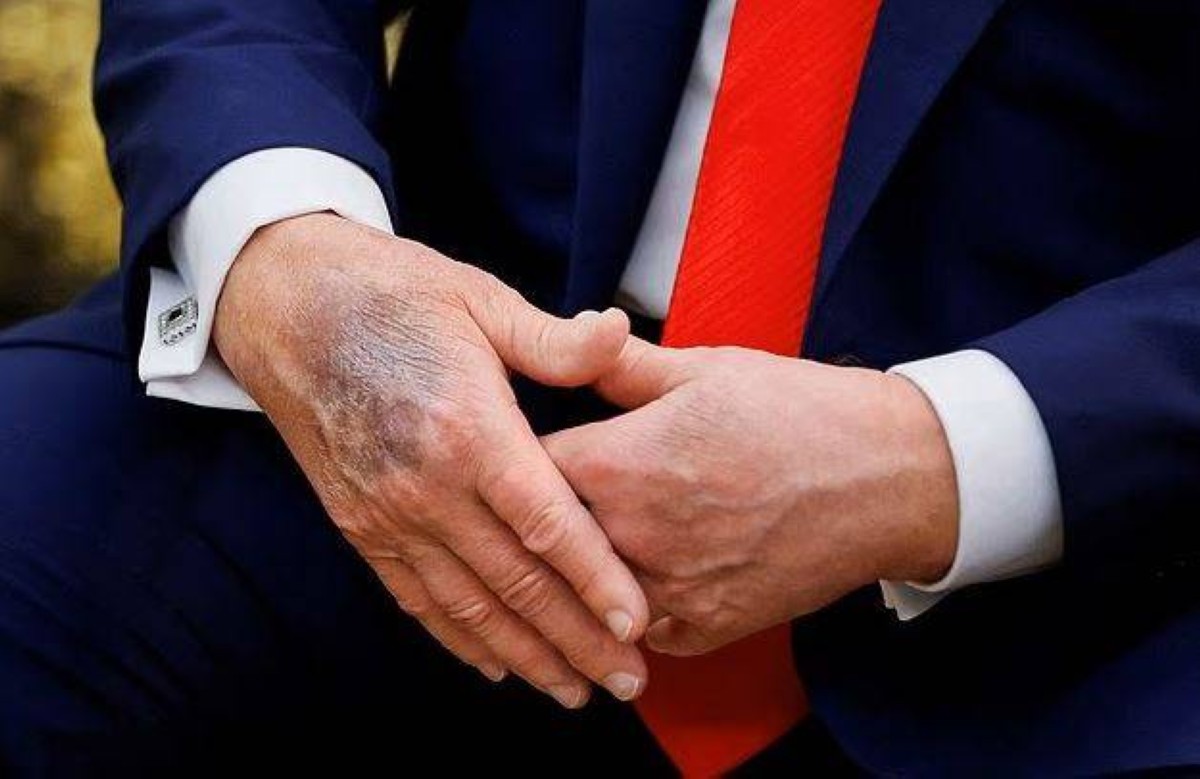 صحة ترامب على المحك.. كدمات جديدة تثير التساؤلات رغم تطمينات البيت الأبيض