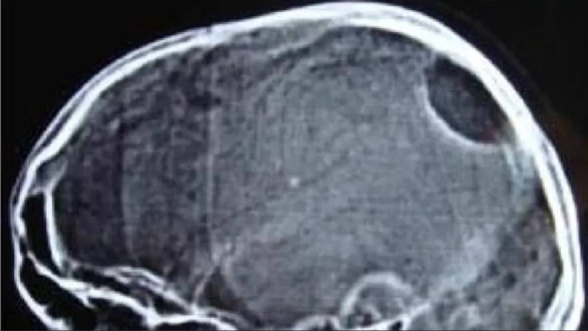 300 حالة فقط في العالم.. مرض يلتهم العظام دون إنذار